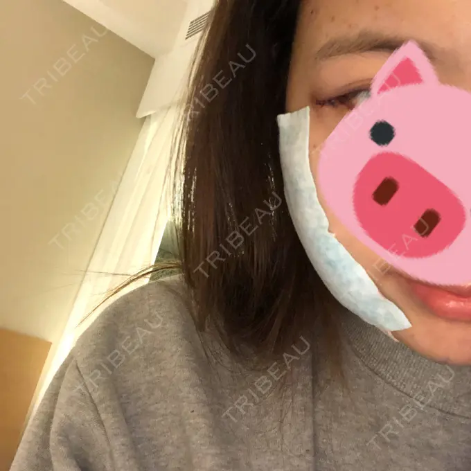 バッカルファット除去 / 脂肪吸引（顔） / 目尻切開 / 水光注射（ハリ・美肌） / ヒアルロン酸注入（あご） / ボトックス（エラ・小顔） / ボトックス（口角） / 白玉点滴・注射 / その他（肌） エートップ美容整形外科 DAY 0 メイン用