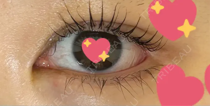 目頭切開 / クマ治療 / 目尻切開 / タレ目形成・グラマラスライン（切開） / 目尻靭帯移動 エターナル美容クリニック AFTER メイン用