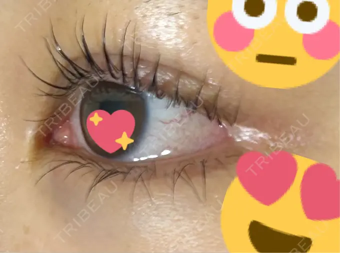 目頭切開 / クマ治療 / 目尻切開 / タレ目形成・グラマラスライン（切開） / 目尻靭帯移動 エターナル美容クリニック DAY 213 メイン用