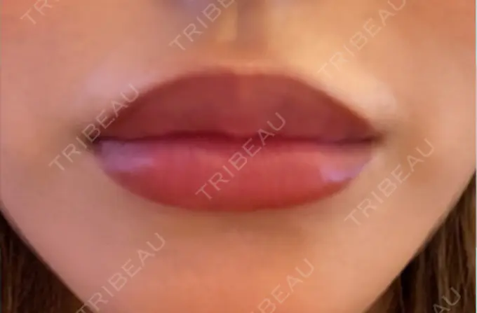ヒアルロン酸注入（唇） 麻布十番クレールデンタルクリニック DAY 8 メイン用