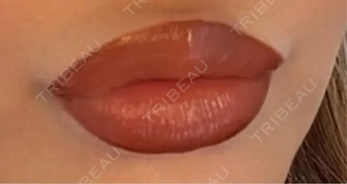 ヒアルロン酸注入（唇） 麻布十番クレールデンタルクリニック DAY 9 メイン用