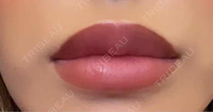 ヒアルロン酸注入（唇） 麻布十番クレールデンタルクリニック DAY 10 メイン用