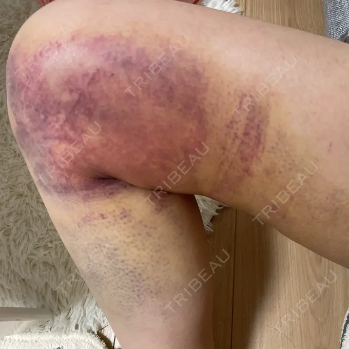 豊胸（脂肪注入） BBC銀座院 DAY 6 メイン用