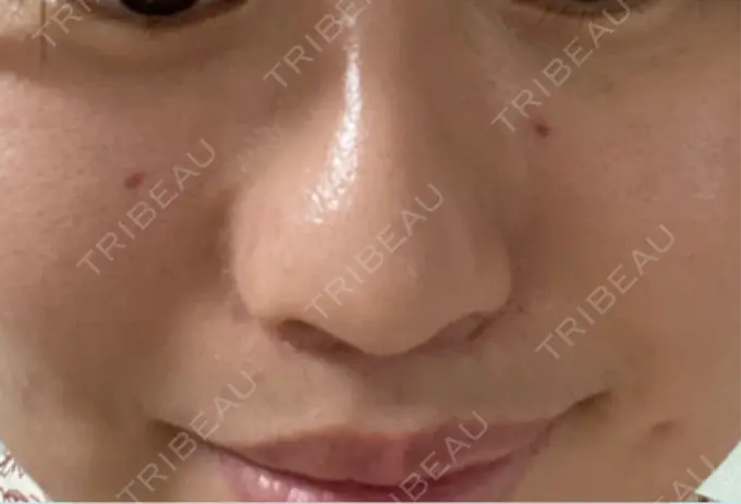 ほくろ・いぼ切除（肌） TCB東京中央美容外科 新潟院 DAY 7 メイン用