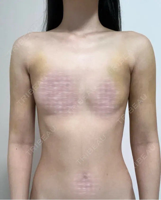 脂肪吸引（二の腕） 4Dクリニック DAY 8 メイン用