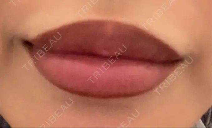 ヒアルロン酸注入（唇） 麻布十番クレールデンタルクリニック DAY 11 メイン用