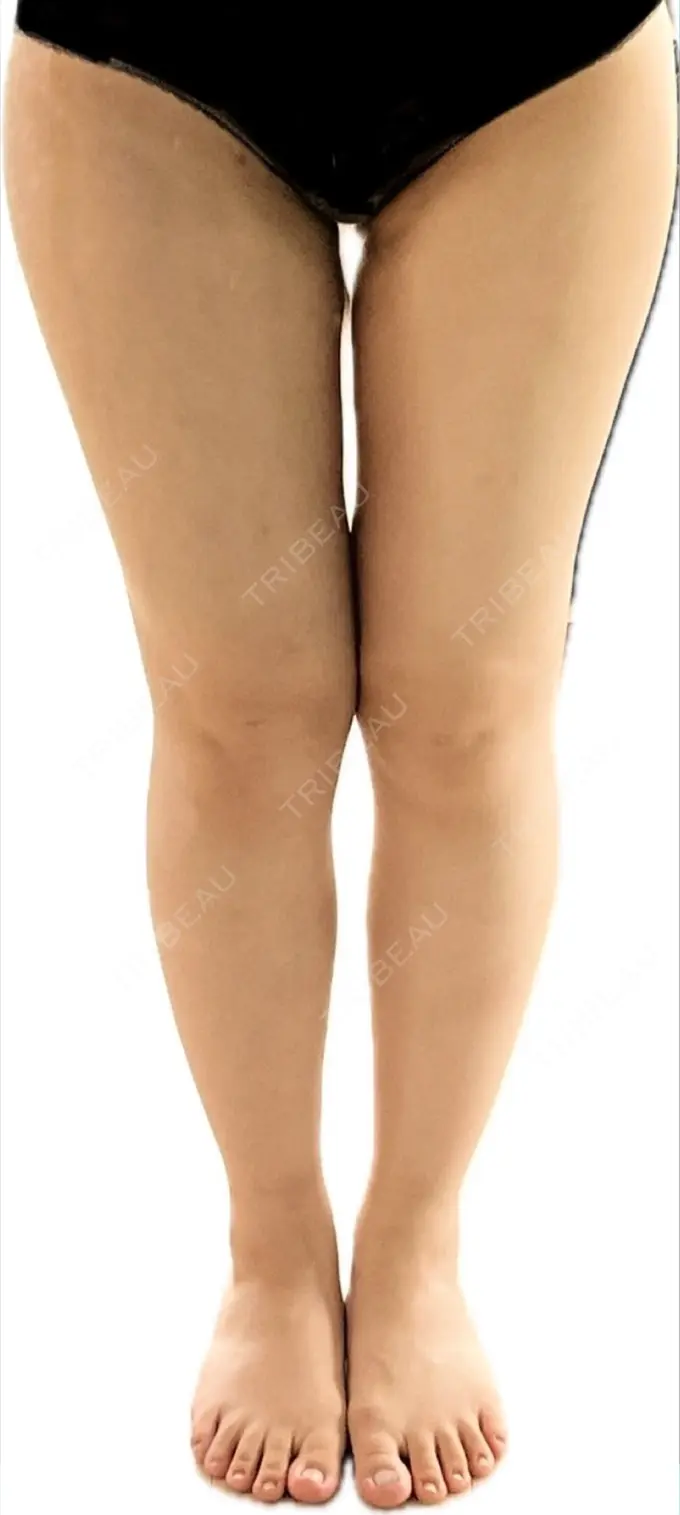 脂肪吸引（脚） Mods Clinic（モッズクリニック） 名古屋院 DAY 30 メイン用