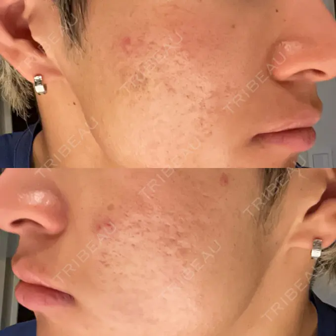 肌ヒアルロン酸注入（たるみ・シワ改善） / その他（肌） / ニキビ治療 ゆきスキンクリニック 東池袋 DAY 6 メイン用