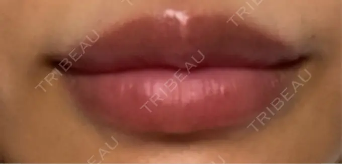 ヒアルロン酸注入（唇） 麻布十番クレールデンタルクリニック AFTER メイン用