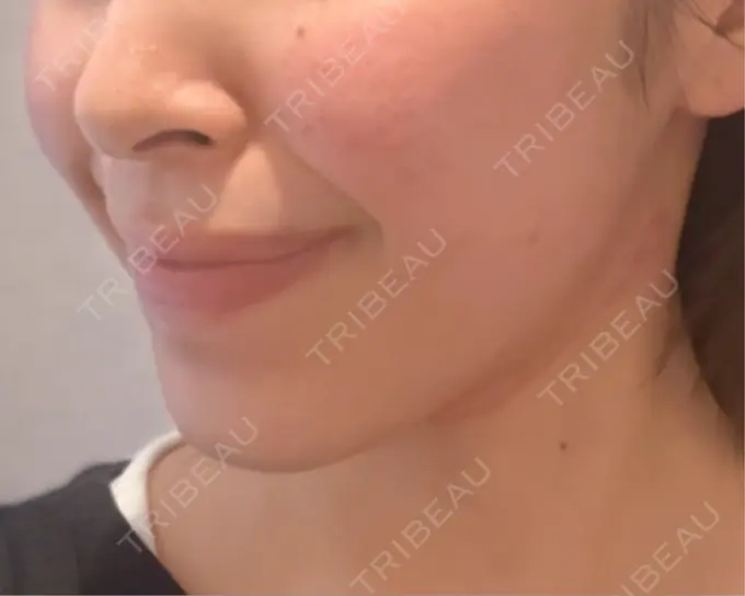 RF（高周波）たるみ治療 表参道メディカルクリニック 表参道院 DAY 0 メイン用