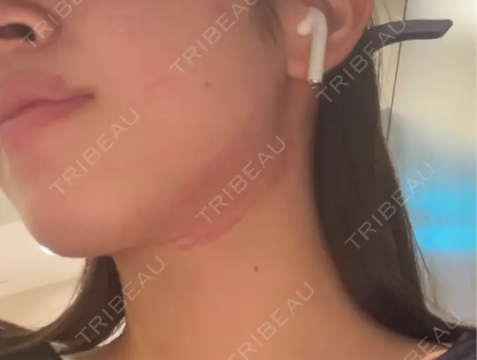 RF（高周波）たるみ治療 表参道メディカルクリニック 表参道院 DAY 0 メイン用