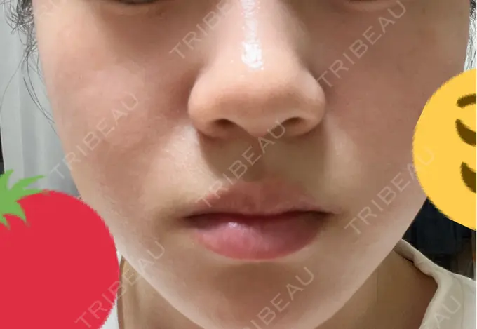 ピーリング（ニキビ・毛穴） 大美会クリニック 梅田院 AFTER メイン用