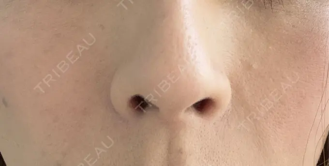 その他（肌） 美容皮膚科エルムクリニック 岡山院 DAY 16 メイン用