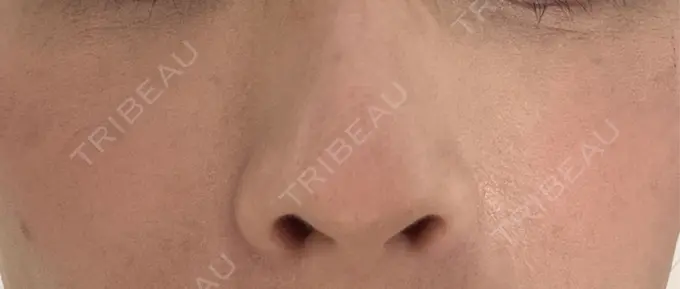 その他（肌） 美容皮膚科エルムクリニック 岡山院 DAY 17 メイン用