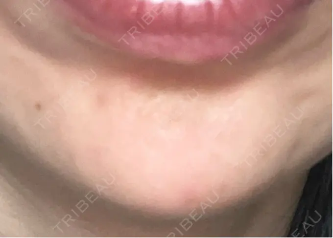 ボトックス（あご） / ボトックス（眉間） / ボトックス（額） 湘南美容クリニック 博多院 AFTER メイン用