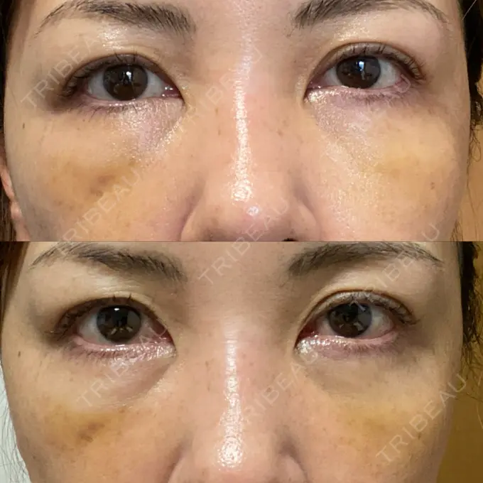 クマ治療 / 下まぶたたるみ取り / ヒアルロン酸注入（目の下） / ボトックス（目尻） TCB東京中央美容外科 神戸院 DAY 6 メイン用