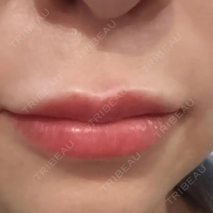 ヒアルロン酸注入（唇） / その他（輪郭） Code Beauty Clinic 名古屋院 DAY 0 メイン用