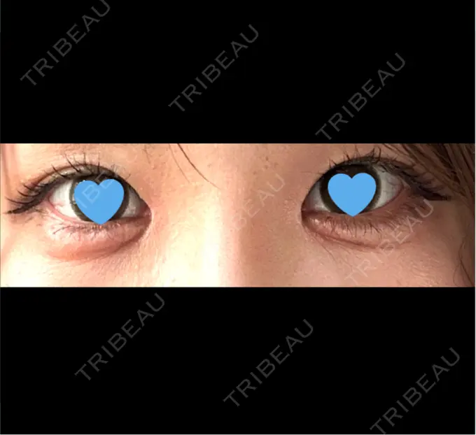 目頭切開 札幌ル・トロワ ビューティクリニックVogue AFTER メイン用