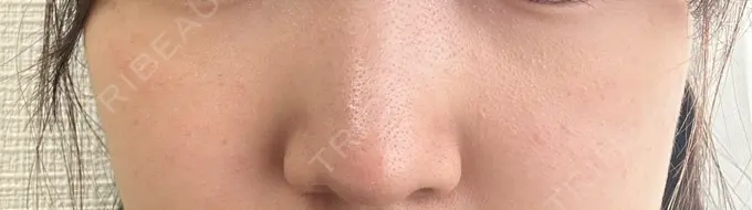 ピコスポット 美容皮膚科エルムクリニック 麻布院 DAY 45 メイン用