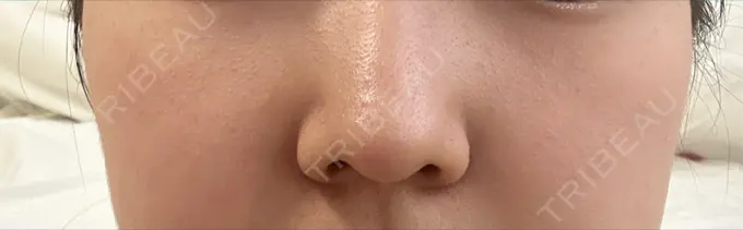 ピコスポット 美容皮膚科エルムクリニック 麻布院 DAY 52 メイン用