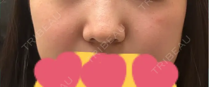 ピコスポット 美容皮膚科エルムクリニック 麻布院 DAY 56 メイン用