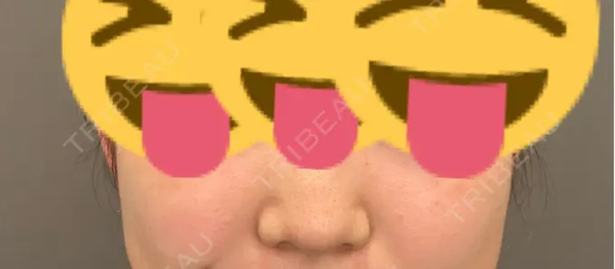 ピコスポット 美容皮膚科エルムクリニック 麻布院 DAY 63 メイン用