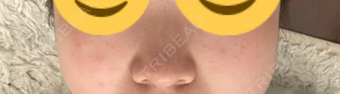 ピコスポット 美容皮膚科エルムクリニック 麻布院 DAY 69 メイン用