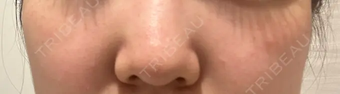 ピコスポット 美容皮膚科エルムクリニック 麻布院 AFTER メイン用