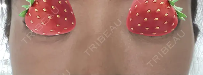 クマ治療 湘南美容クリニック 藤沢院 AFTER メイン用