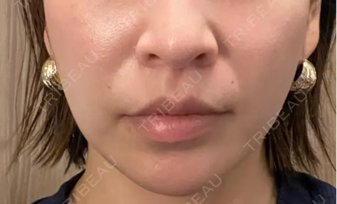 小鼻縮小（切開） / 人中短縮 Otus Clinic 【オータスクリニック】 AFTER メイン用