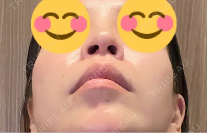 小鼻縮小（切開） / 人中短縮 Otus Clinic 【オータスクリニック】 DAY 112 メイン用