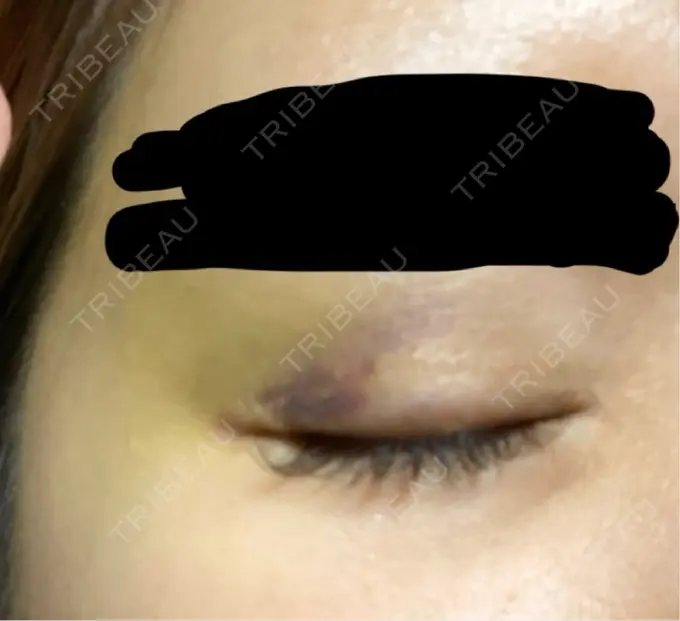 ヒアルロン酸注入（唇） / ヒアルロン酸注入（額） / ヒアルロン酸注入（こめかみ） ziz CLINIC DAY 8 メイン用