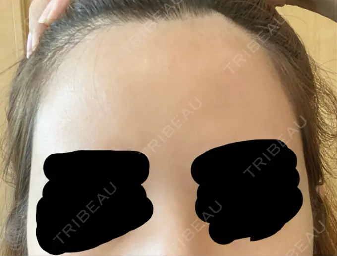 ヒアルロン酸注入（唇） / ヒアルロン酸注入（額） / ヒアルロン酸注入（こめかみ） ziz CLINIC AFTER メイン用