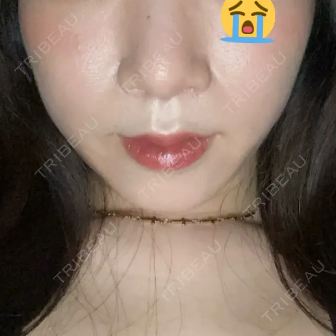 人中短縮 / 鼻翼挙上 / 鼻尖縮小 Otus Clinic 【オータスクリニック】 DAY 41 メイン用