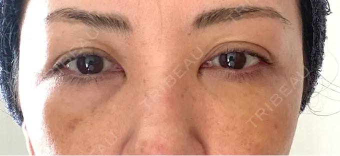 クマ治療 / 下まぶたたるみ取り / ヒアルロン酸注入（目の下） / ボトックス（目尻） TCB東京中央美容外科 神戸院 DAY 7 メイン用