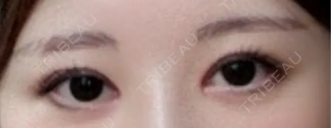 眼瞼下垂（非切開） SOL CLINIC AFTER メイン用