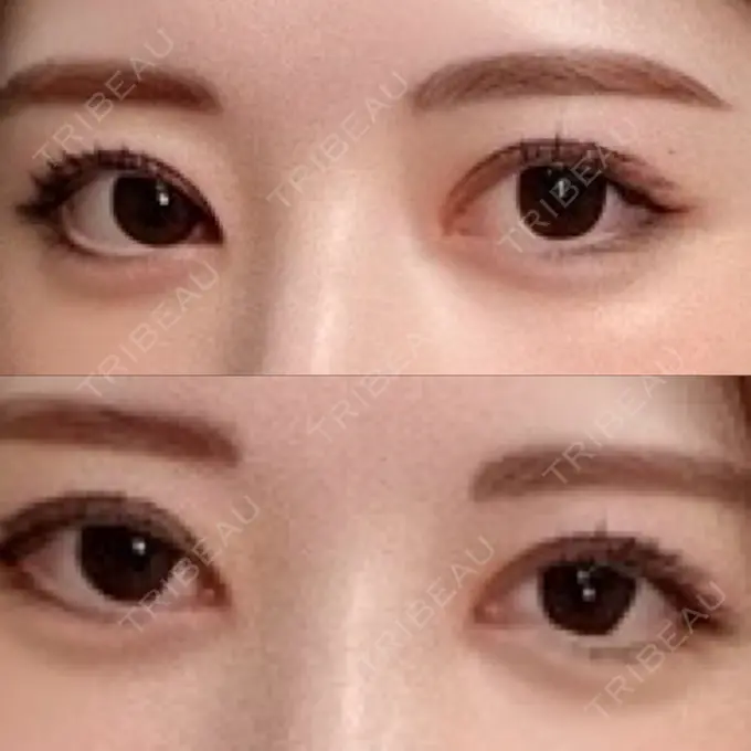 二重埋没 / 目頭切開 / クマ治療 ROOTS Clinic DAY 64 メイン用