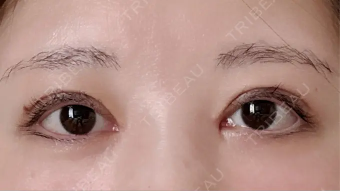 二重埋没 / 目頭切開 / クマ治療 ROOTS Clinic DAY 64 メイン用