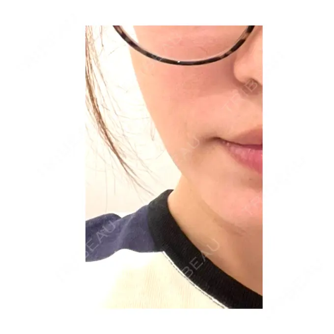 肌ヒアルロン酸注入（たるみ・シワ改善） / ボトックス（エラ・小顔） TCB東京中央美容外科 池袋駅前院 DAY 0 メイン用