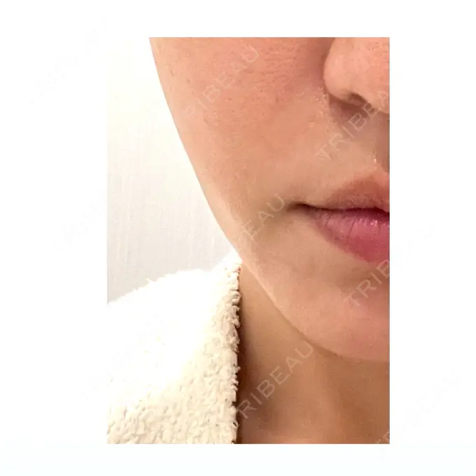 肌ヒアルロン酸注入（たるみ・シワ改善） / ボトックス（エラ・小顔） TCB東京中央美容外科 池袋駅前院 DAY 2 メイン用