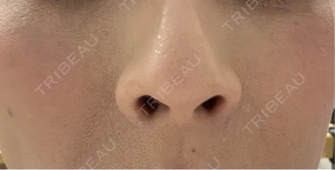 その他（肌） 美容皮膚科エルムクリニック 岡山院 AFTER メイン用