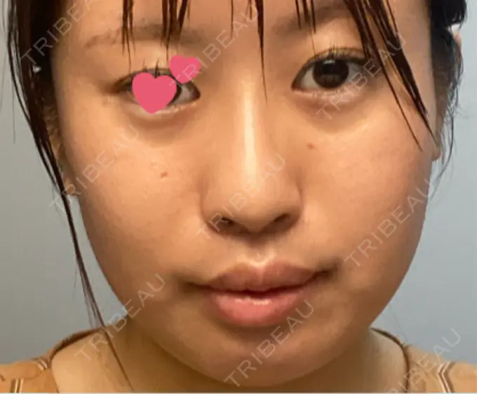 ほくろ・いぼ切除（肌） TCB東京中央美容外科 新潟院 DAY 10 メイン用