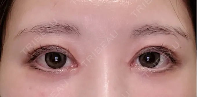 二重埋没 / 目頭切開 / クマ治療 ROOTS Clinic AFTER メイン用