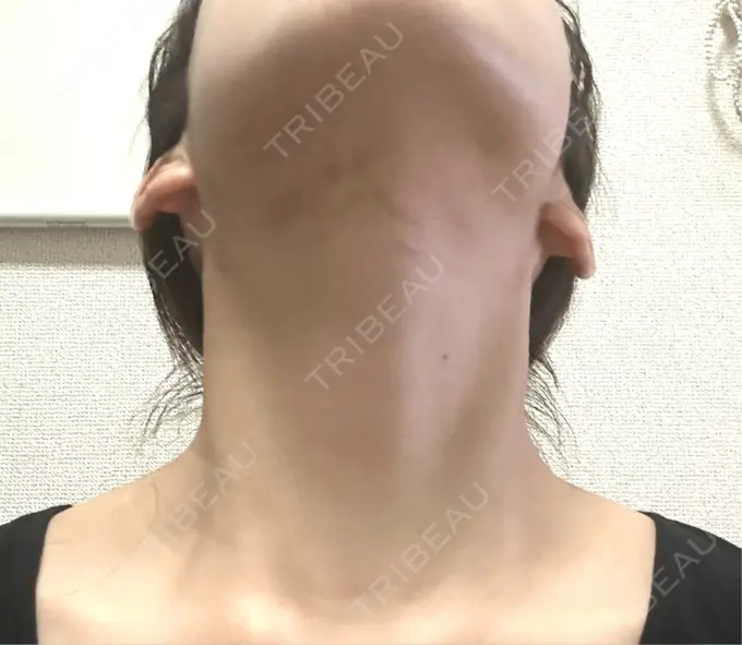 RF（高周波）たるみ治療 表参道メディカルクリニック 表参道院 DAY 1 メイン用