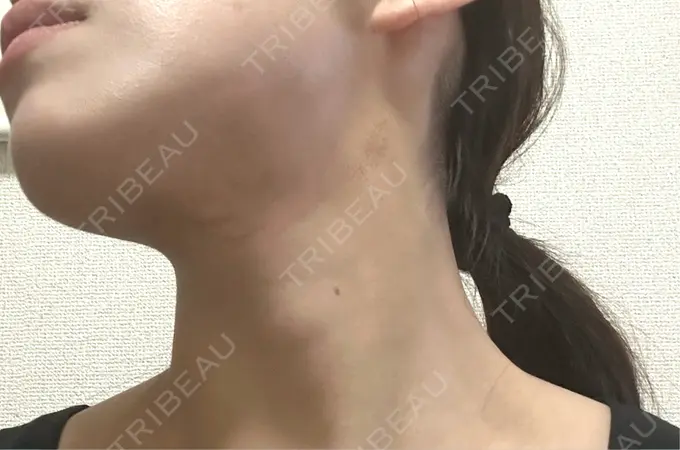 RF（高周波）たるみ治療 表参道メディカルクリニック 表参道院 AFTER メイン用