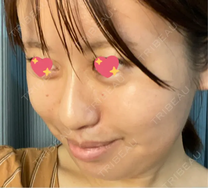 ほくろ・いぼ切除（肌） TCB東京中央美容外科 新潟院 DAY 10 メイン用