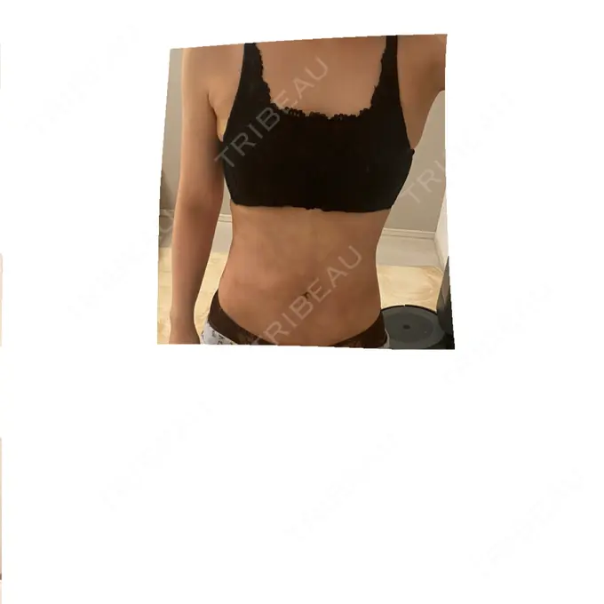 脂肪吸引（二の腕） / 脂肪吸引（腰） / 脂肪吸引（肩） / 医療脱毛（お腹） Mods Clinic（モッズクリニック） 大阪院 DAY 41 メイン用