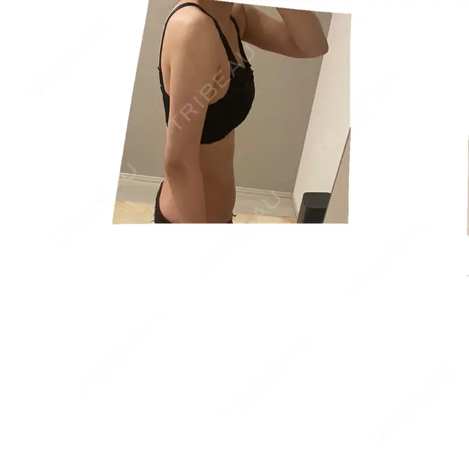 脂肪吸引（二の腕） / 脂肪吸引（腰） / 脂肪吸引（肩） / 医療脱毛（お腹） Mods Clinic（モッズクリニック） 大阪院 DAY 41 メイン用