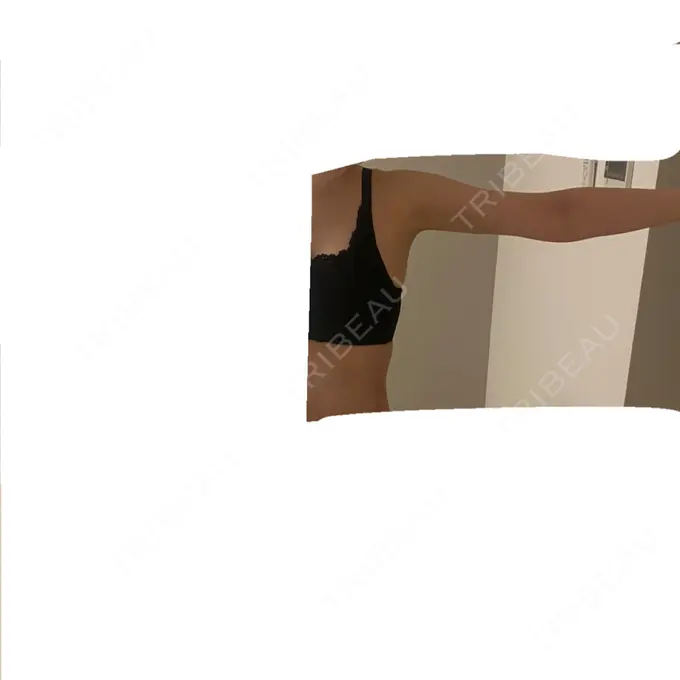 脂肪吸引（二の腕） / 脂肪吸引（腰） / 脂肪吸引（肩） / 医療脱毛（お腹） Mods Clinic（モッズクリニック） 大阪院 DAY 41 メイン用