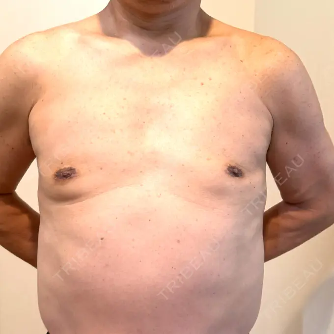 胸修正 / その他（胸） Mods Clinic（モッズクリニック） 大阪院 DAY 186 メイン用